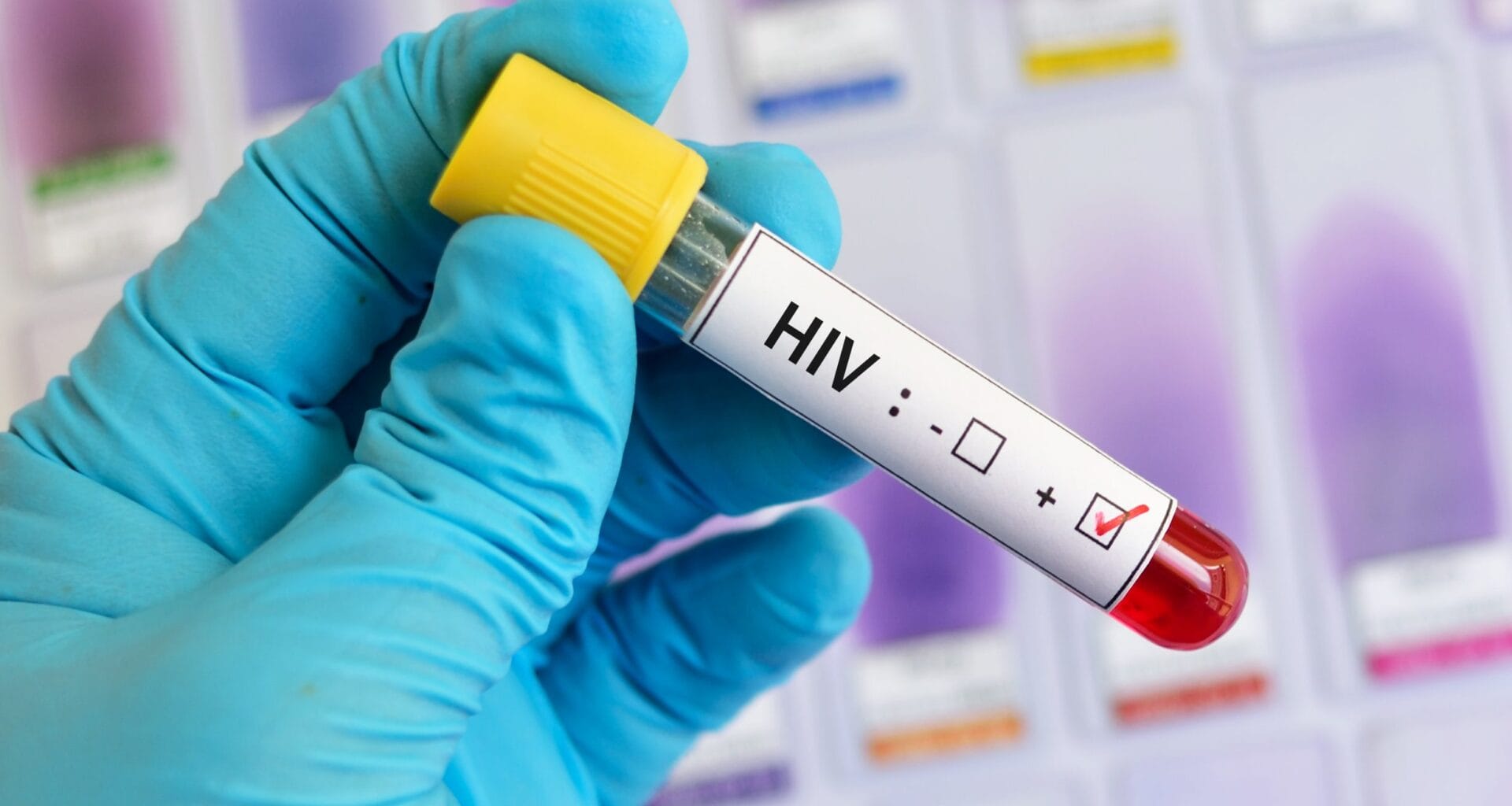 Entenda Os Riscos Da Nova Variante Do Hiv