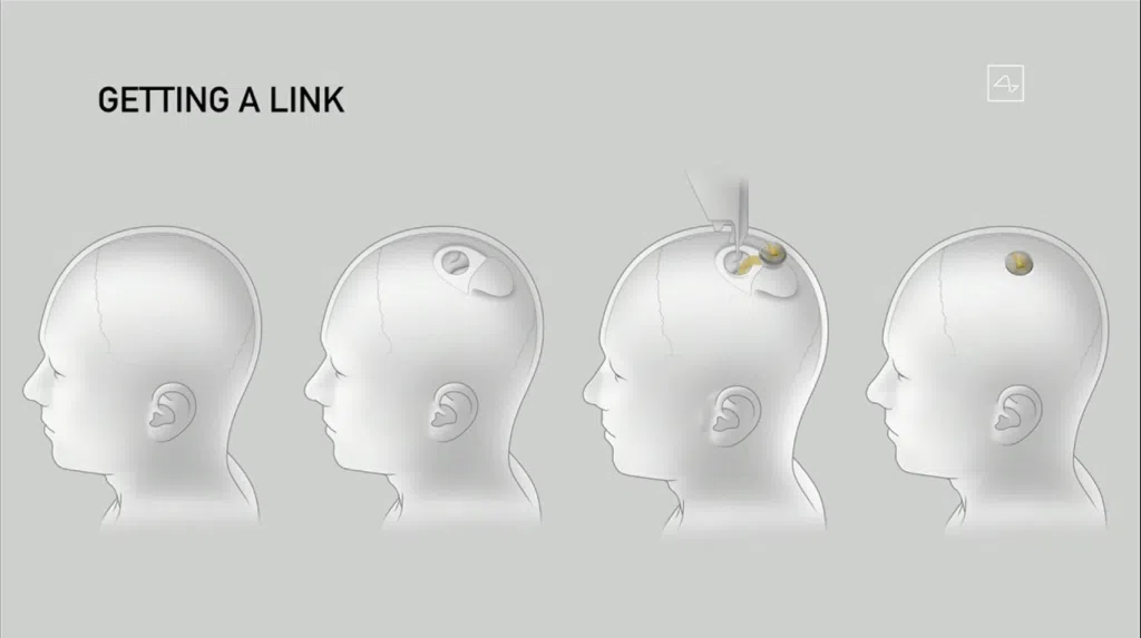 Processo que exemplifica a cirurgia de implante do neuralink: a empresa diz que ela não dura mais de uma hora e não exige nem anestesia geral (captura de imagem: rafael arbulu/showmetech)