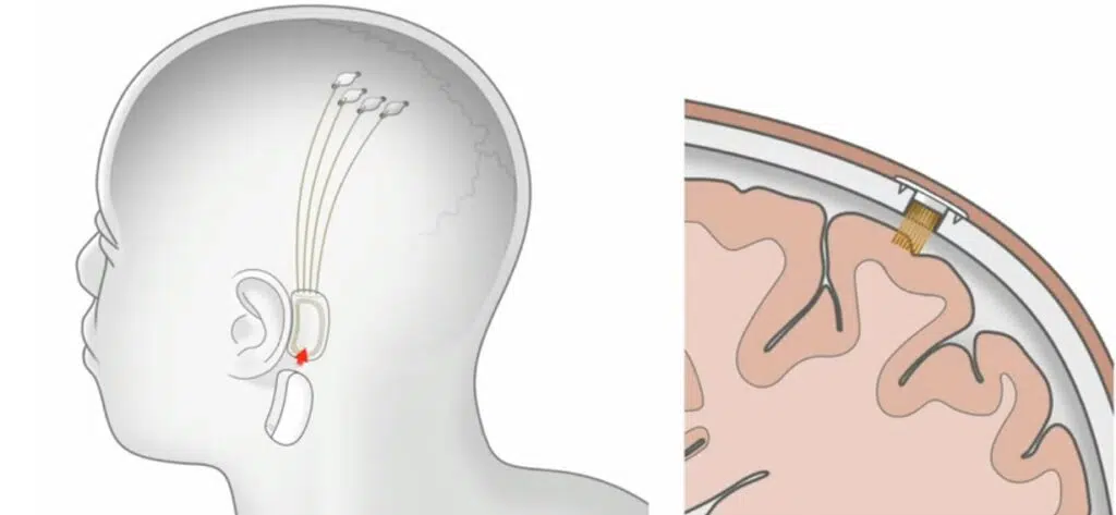 Imagens de funcionamento do neuralink