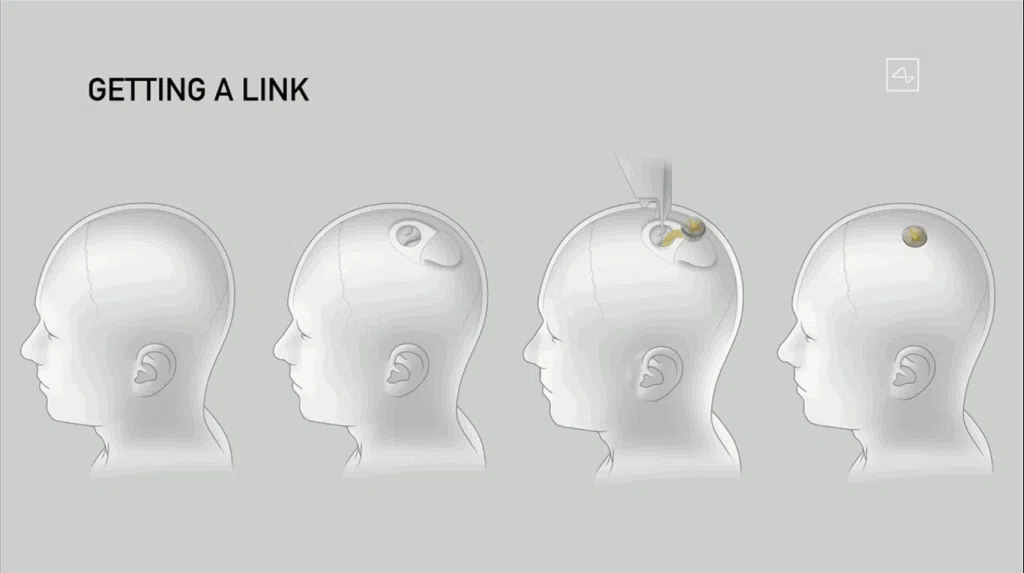 Exemplicação do implante cerebral da neuralink